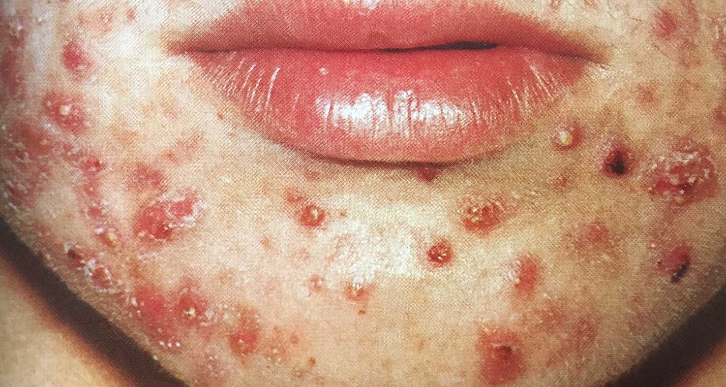 acne kin.jpg
